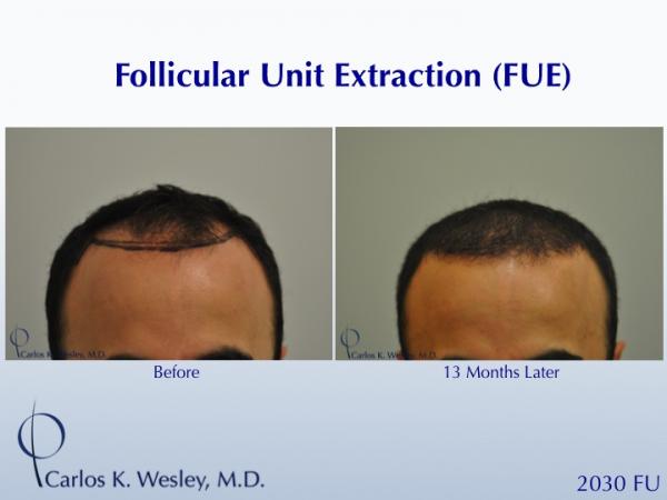 Before and 13 months after FUE with Carlos K. Wesley (NYC).