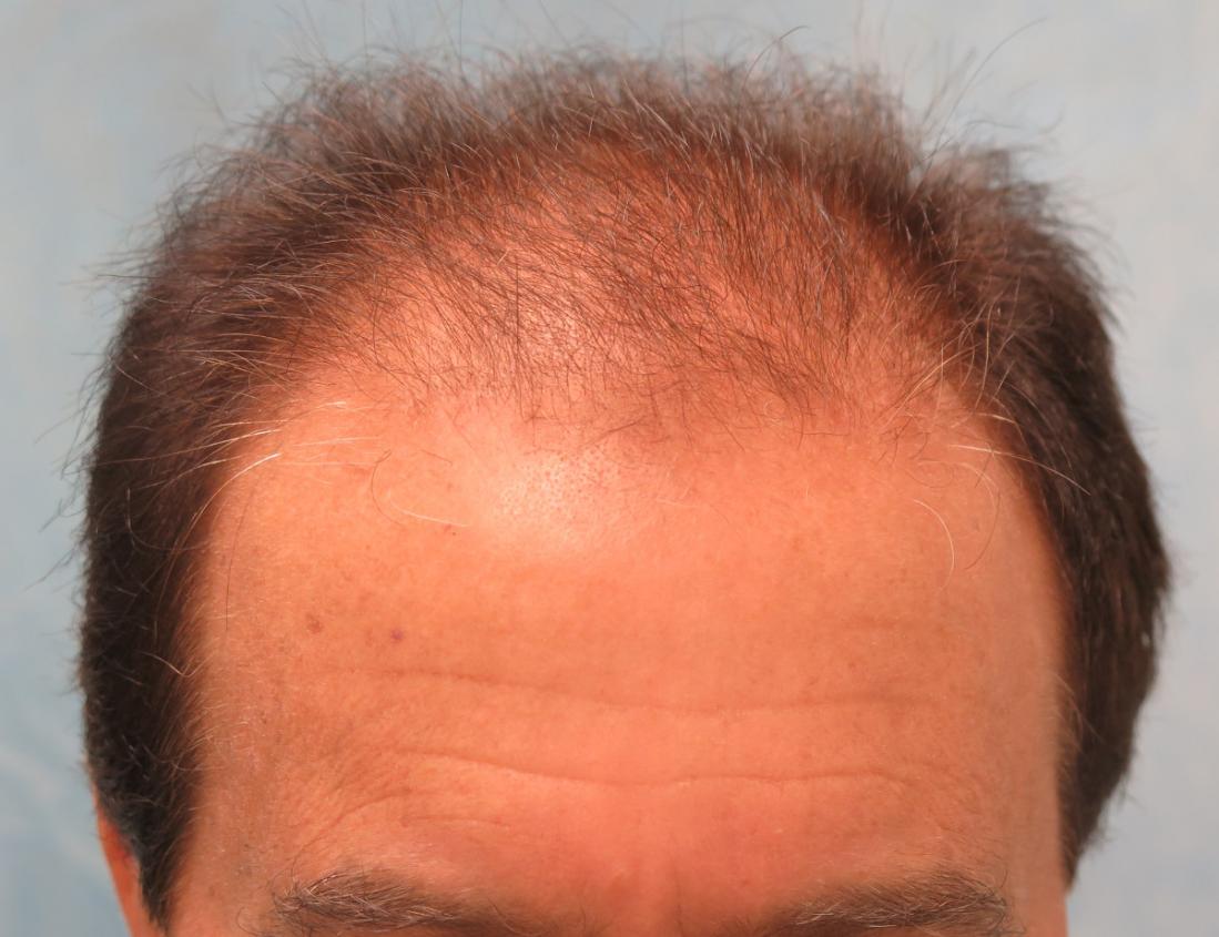 Before Hair Transplant