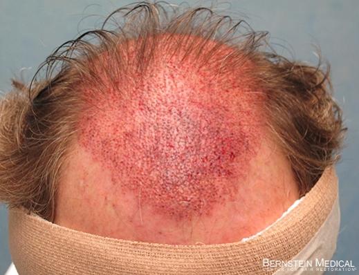 Bernstein Medical's Patient FVR, after 2,941 FU grafts placed in the front and top of the scalp - Top View 
 
View his full photoset >>...