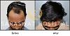Hair Transplant Results Agra