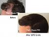 Click image for larger version

Name:	Hair Transplant Slides9.279.jpg

Size:	70.2 KB
ID:	35207