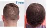 Click image for larger version

Name:	hairline after 1 year back and top.jpg

Size:	17.9 KB
ID:	68154