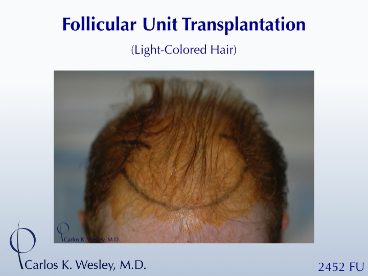 This patient can be seen before/after a 2452 grafts session with Dr. Wesley's office in NYC. 
 
An interactive before/after image of this patient can...