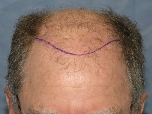 Click image for larger version

Name:	05_position-of-hairline.jpg

Size:	55.6 KB
ID:	8898