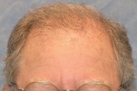 Click image for larger version

Name:	06_after-1st-hair-transplant.jpg

Size:	48.8 KB
ID:	8899