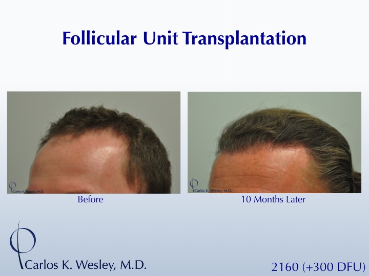 A 40-year-old male underwent a 2460 FU session of FUT with Dr. Carlos K. Wesley (NYC).