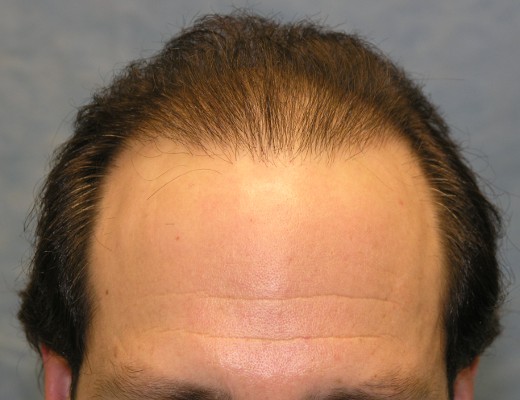 Click image for larger version

Name:	05_after-1st-hair-transplant.jpg

Size:	49.8 KB
ID:	7898