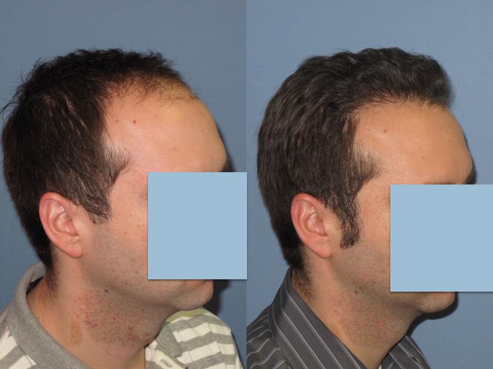 Paul Shapiro, MD 
FUT 3113 grafts 
12 months post-op