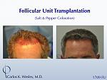 A video montage of this patient's transformation may be viewed here: 
 
https://vimeo.com/67214017