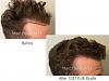 Click image for larger version

Name:	FUE hairline and eyebrow.002.jpg

Size:	12.6 KB
ID:	54212