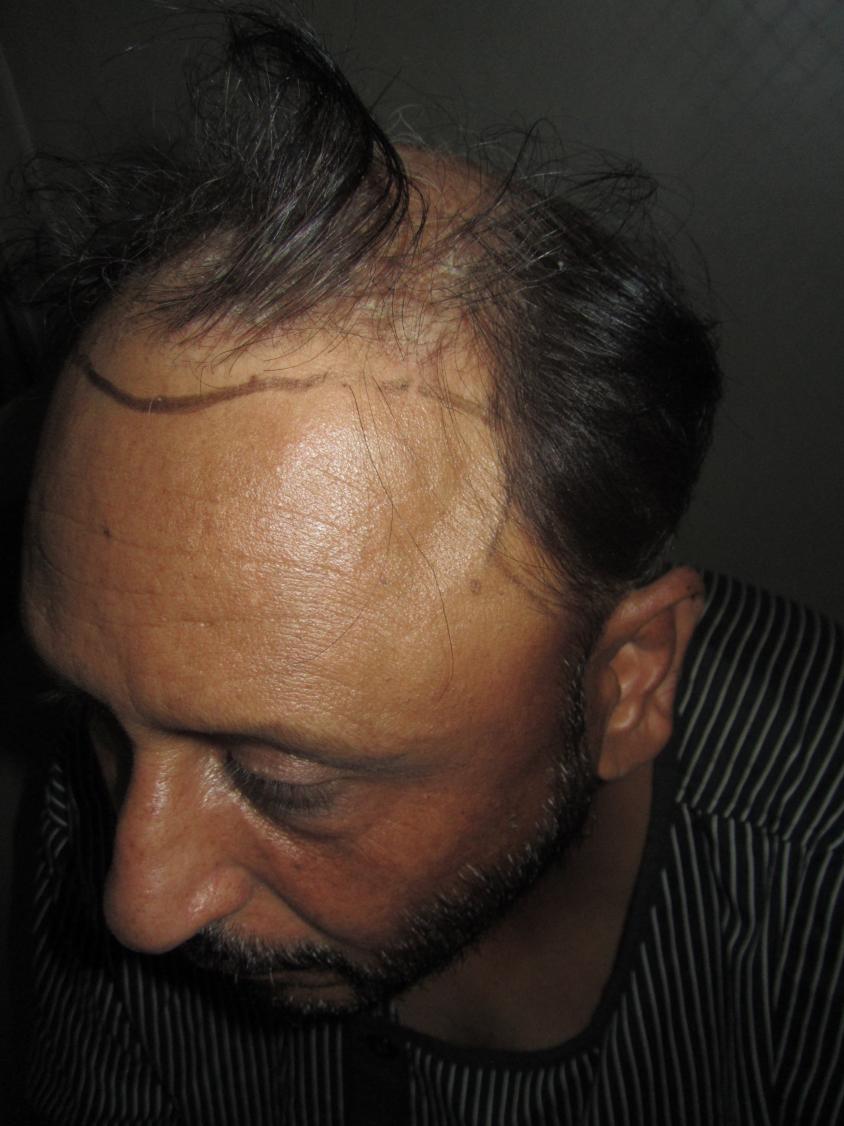 Click image for larger version

Name:	Darling Buds Hair Transplant @Chandigarh (3).jpg

Size:	91.6 KB
ID:	25360