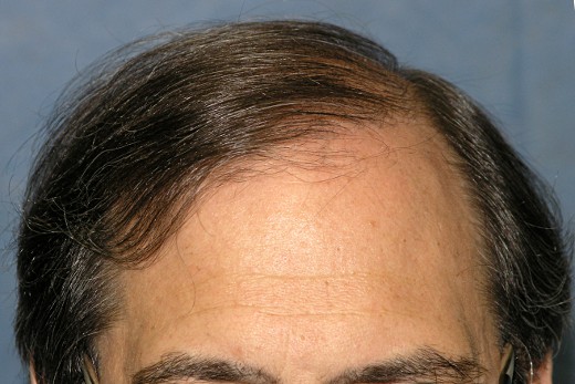 Click image for larger version

Name:	04_after-1st-hair-transplant.jpg

Size:	60.5 KB
ID:	8031