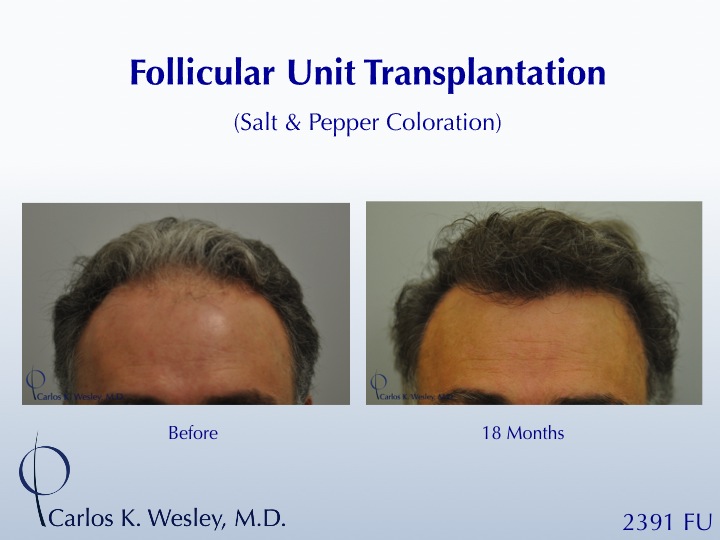 46-year-old male with curly hair of salt & pepper coloration46-year-old male with curly hair of salt & pepper coloration underwent two sessions...