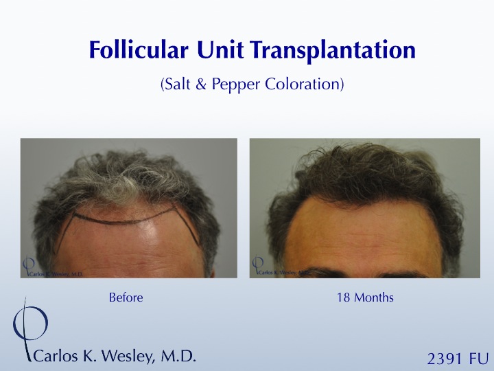 46-year-old male with curly hair of salt & pepper coloration underwent two sessions totaling 4637 FU with Dr. Carlos K. Wesley (NYC).