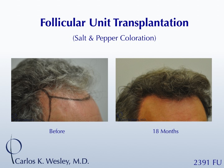 46-year-old male with curly hair of salt & pepper coloration underwent two sessions totaling 4637 FU with Dr. Carlos K. Wesley (NYC).