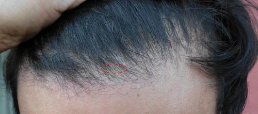 Click image for larger version

Name:	Hairline - 11 months post-op.jpg

Size:	20.2 KB
ID:	13613