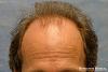 Bernstein Medical's Patient JKJ before hair transplant - Detail of Hairline 
 
View his full photoset >>...
