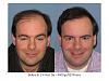 Dr. Paul Shapiro, MD 
FUT 
4000 grafts/8274 hairs 
12 months post-op
