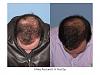 Dr. Paul Shapiro, MD 
FUT 
4000 grafts/8274 hairs 
12 months post-op