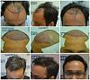 4302 hair implanted,7 months result
