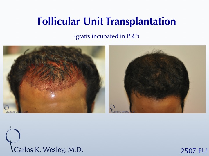 22-year-old male before and after 2507 grafts to the frontal third of his scalp by Dr. Carlos K. Wesley.  A video montage of his transformation can...