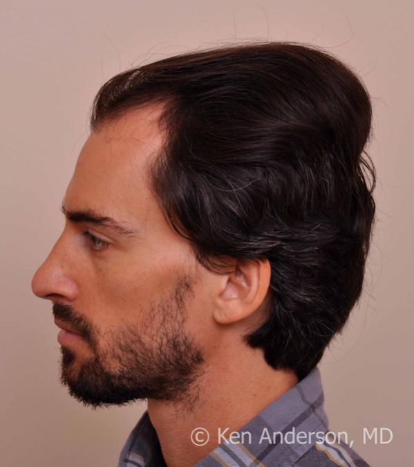 Jason Nicola	 
Norwood 3 
Age: 34 
Surgeon: Dr. Ken Anderson, MD 
Location: Atlanta, Georgia 
	 
Clinical History: 
Jasons initial consultation with...