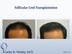 35-year-old male as seen before/after 1897 graft session with Dr. Carlos K. Wesley in NYC. 
 
A video of this patient's experience can be viewed...