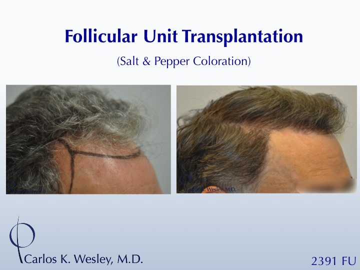 This patient is seen Before/After a 2391 graft 
session with Carlos K. Wesley, M.D. 
 
An interactive Before/After image of this patient can be...