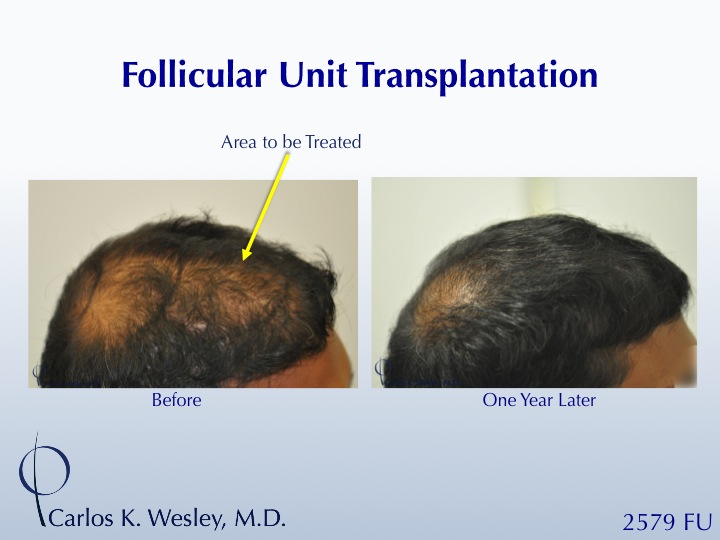 A 34-year-old male had 2579 FU added to his mid scalp to minimize his balding crown.