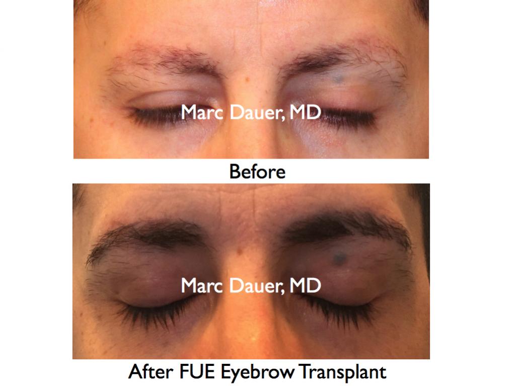 Click image for larger version

Name:	Hair Transplant Slides.438.jpg

Size:	62.0 KB
ID:	37202