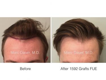 Dr. Marc Dauer hair transplant photos