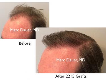 Click image for larger version

Name:	Hair Transplant Slides3.002.jpg

Size:	11.7 KB
ID:	42440