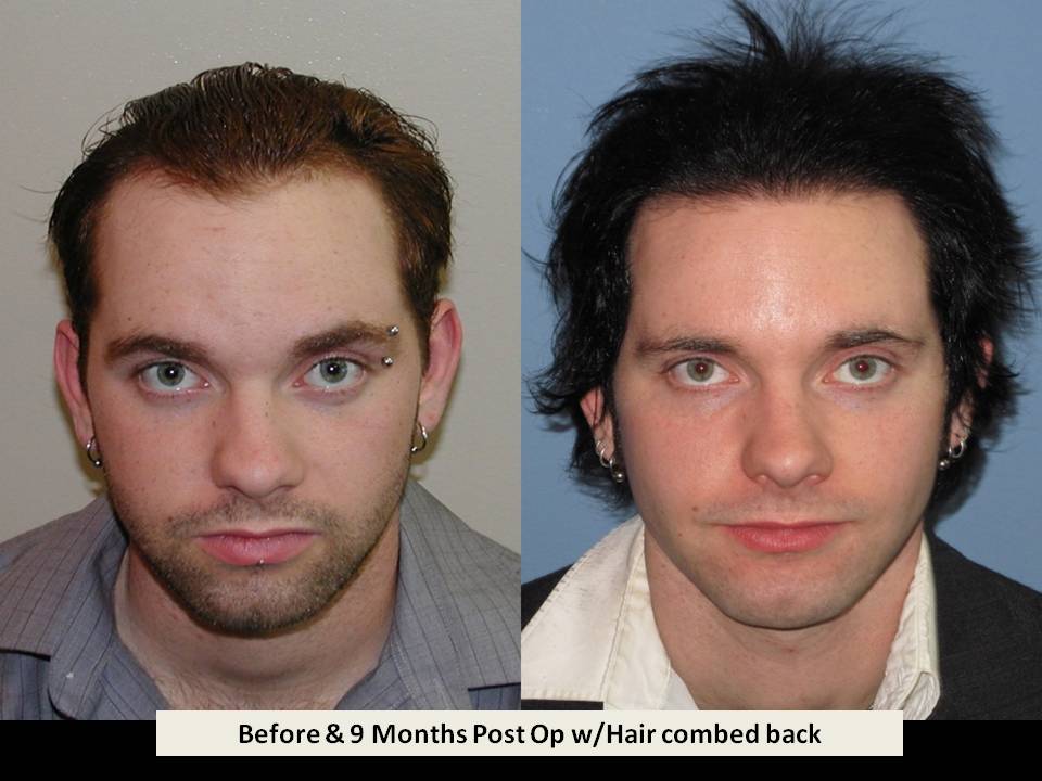 Dr. Paul Shapiro 
FUT 
2631 grafts/4742 hairs 
9 months post-op