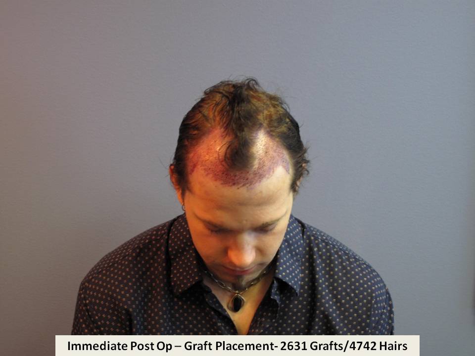 Dr. Paul Shapiro 
FUT 
2631 grafts/4742 hairs 
9 months post-op