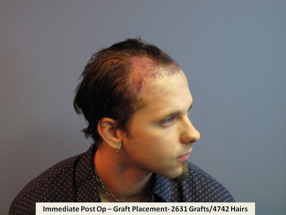 Dr. Paul Shapiro 
FUT 
2631 grafts/4742 hairs 
9 months post-op