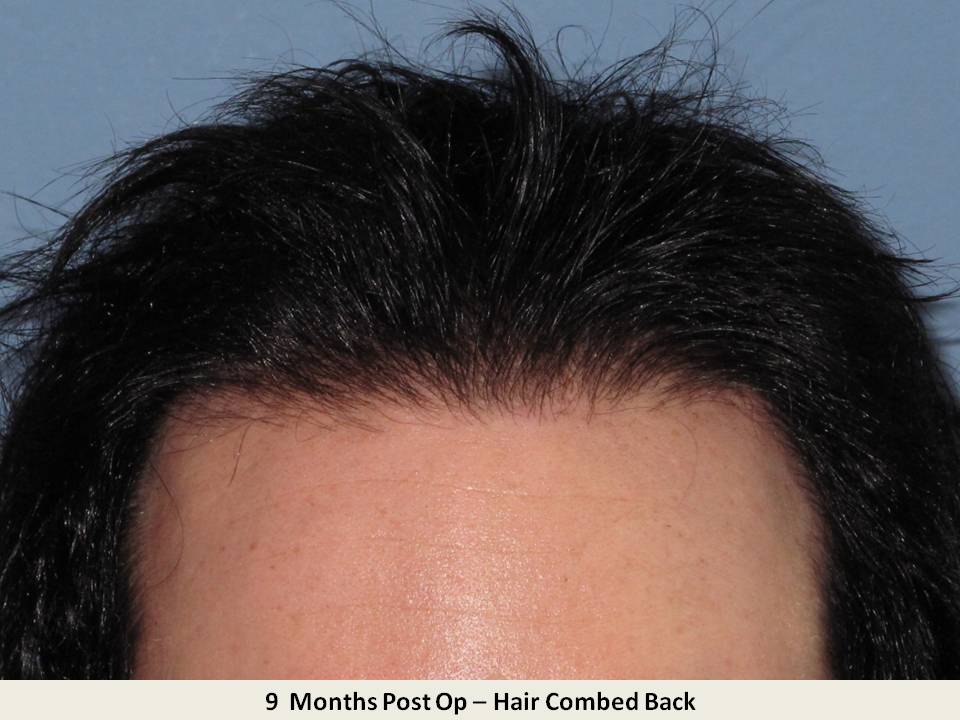 Dr. Paul Shapiro 
FUT 
2631 grafts/4742 hairs 
9 months post-op