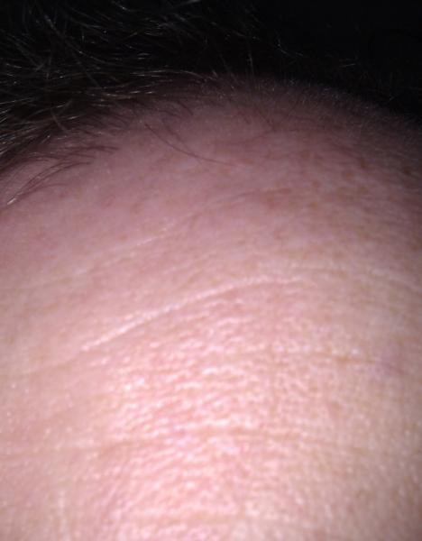 Hair peach fuzz growth - Day 5 TRX-2.