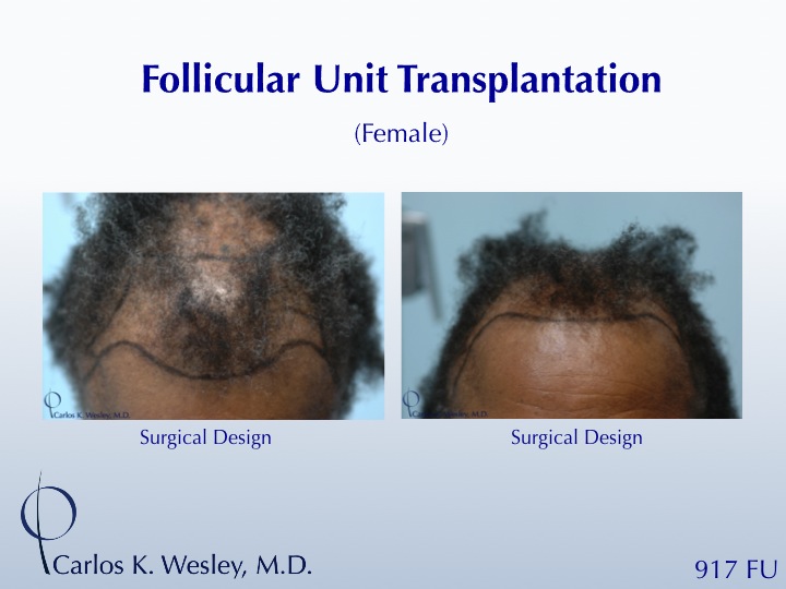 Female Patient Before/After a 917 grafts session with Dr. Carlos K. Wesley in NYC. 
 
An interactive before/after image of this patient may be viewed...