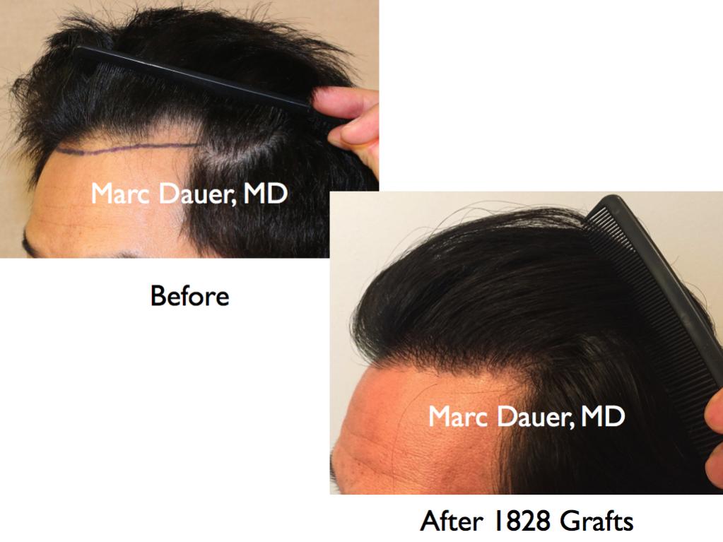 Click image for larger version

Name:	Hair Transplant Slides.476.jpg

Size:	64.4 KB
ID:	37446