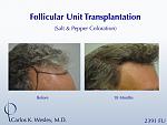 46-year-old male with curly hair of salt & pepper coloration underwent two sessions totaling 4637 FU with Dr. Carlos K. Wesley (NYC).