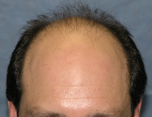 Click image for larger version

Name:	03_before-hair-transplant.jpg

Size:	50.0 KB
ID:	7896