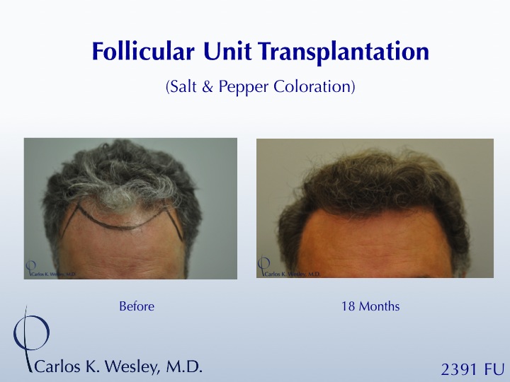 46-year-old male with curly hair of salt & pepper coloration underwent two sessions totaling 4637 FU with Dr. Carlos K. Wesley (NYC).