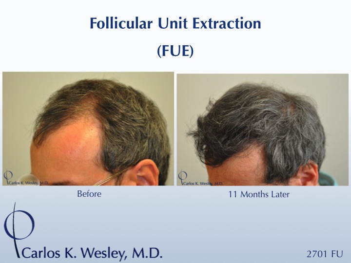 Follicular Unit Extraction (FUE) with Dr. Carlos K. Wesley in New York City.  Before/After 2701 FUE grafts using a combination of 0.8mm and 0.9mm...