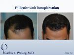 This patient presented at age 30 with coarse straight black hair that had progressively receded throughout his frontal third. A session involving...