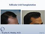 This patient presented at age 30 with coarse straight black hair that had progressively receded throughout his frontal third. A session involving...