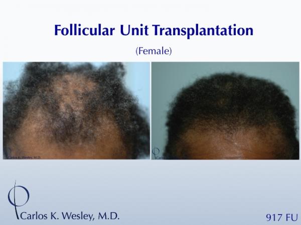 Female Patient Before/After a 917 grafts session with Dr. Carlos K. Wesley in NYC. 
 
An interactive before/after image of this patient may be viewed...