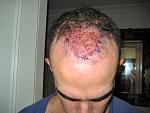 Day1 FUE Hair Transplant Dr Woods - Shot once I got home this is the area that was implants - 500 grafts