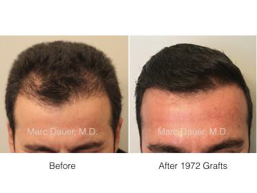 Marc Dauer, MD-1972 Grafts FUT