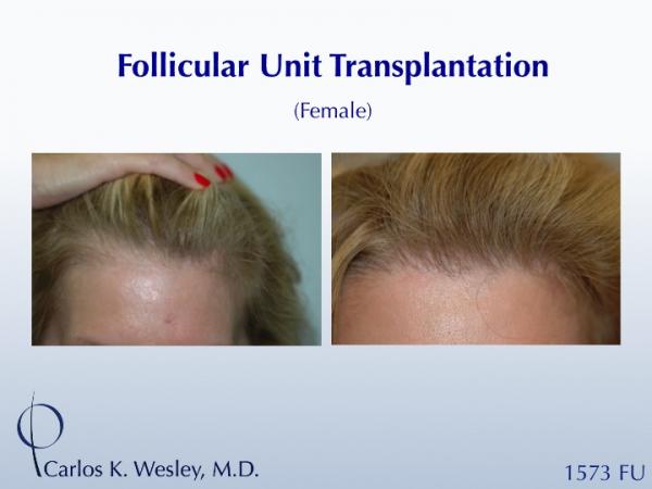 Before/After of a female patient undergoing a 1573 graft session with the NYC practice of Dr. Carlos K. Wesley. 
 
An interactive before/after image...