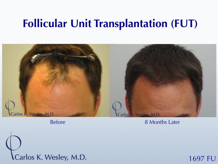 1700 FUT session for a 44-year-old gentleman.  Only 8 months after the procedure, early growth appreciated.